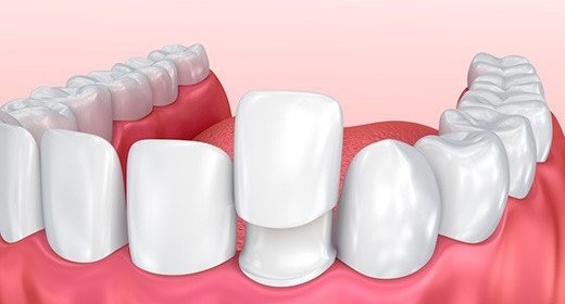 کامپوزیت دندانی