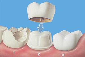 پروتز متحرک و ثابت دندان