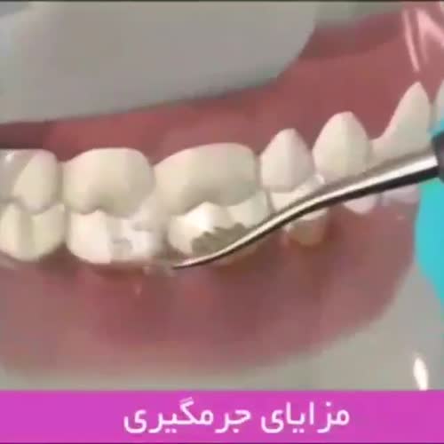 تاثیر جرمگیری روی دندان